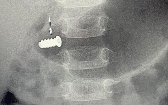 Üç yaşlı uşağın mədəsində şurup qaldı – Foto Üç yaşlı uşağın mədəsində şurup qaldı – Foto