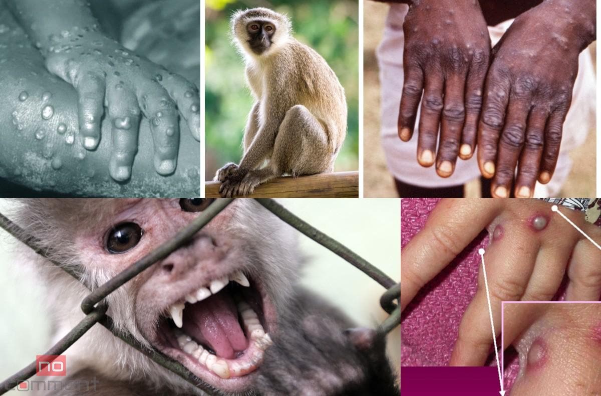 Meymun çiçəyi virusu nə qədər təhlükəlidir? – Əlamətləri Meymun çiçəyi virusu nə qədər təhlükəlidir? – Əlamətləri