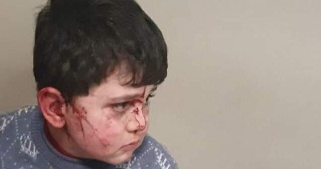 Gəncədə yaralanan uşaq: Daşın altında qaldım