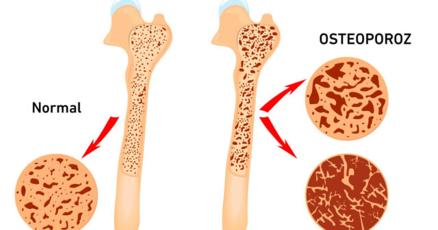 Osteoporoz üçün hansı meyvə və tərəvəzlər yaxşıdır?