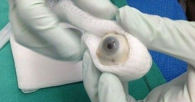 Tibdə ilk: Göz transplantasiyası keçirildi