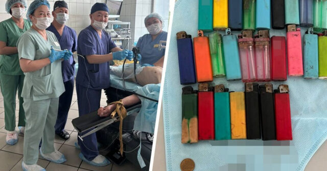 Rusiyada həkimlər 27 alışqan udan kişini xilas edib