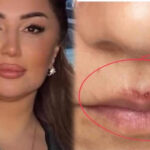 “Beautytime” salonunda qalmaqal: Müştərinin üzü lazerlə yandırılıb? – VİDEO