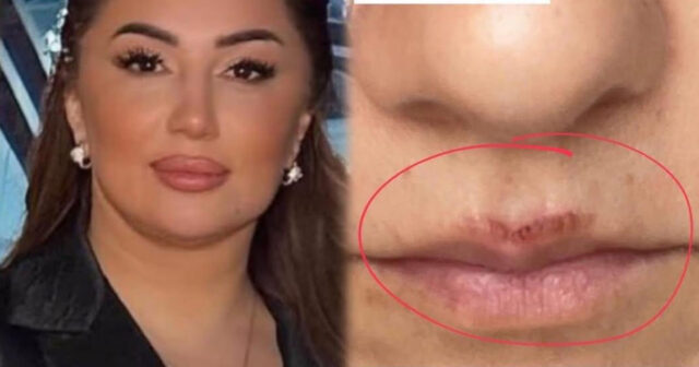 “Beautytime” salonunda qalmaqal: Müştərinin üzü lazerlə yandırılıb? – VİDEO
