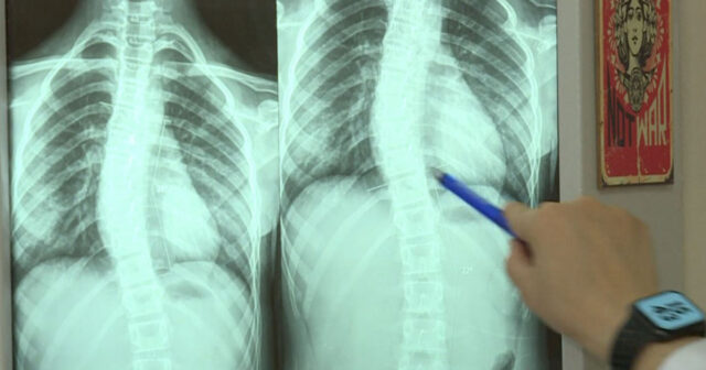 Son zamanlar “8-12” yaş arası uşaqlarda bel və boyun ağrılarının çoxalması nədəndir? – VİDEO