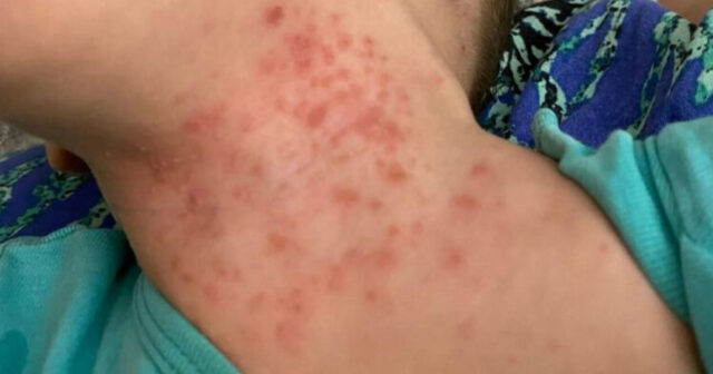 Uşaqlar arasında yeni virus yayılıb? – AÇIQLAMA Uşaqlar arasında yeni virus yayılıb? – AÇIQLAMA