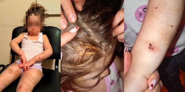 Bakıda ananın azyaşlı qızına verdiyi işgəncələr: Bədəni yandırılıb, kəmərlə döyülüb – TƏFƏRRÜAT Bakıda ananın azyaşlı qızına verdiyi işgəncələr: Bədəni yandırılıb, kəmərlə döyülüb – TƏFƏRRÜAT