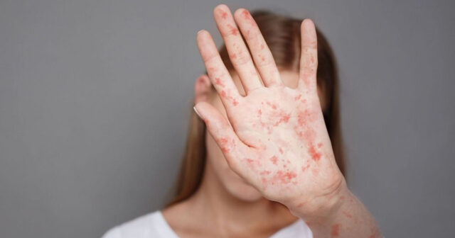 Azərbaycanda qızılca KABUSU geri qayıdır? – 10 yoluxma… Azərbaycanda qızılca KABUSU geri qayıdır? – 10 yoluxma…